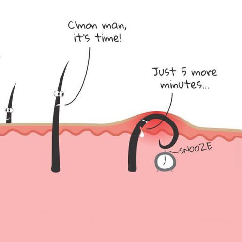 Kako za vedno preprečiti vraščanje dlak