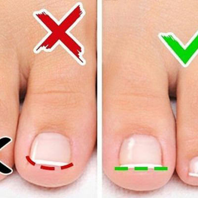 PRAVILNA OBLIKA STRIŽENJA NOHTOV NA NOGI
