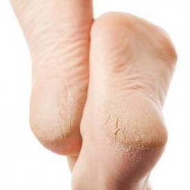 NEGA SUHIH STOPAL Z YUMMI FEET PEDIKURO